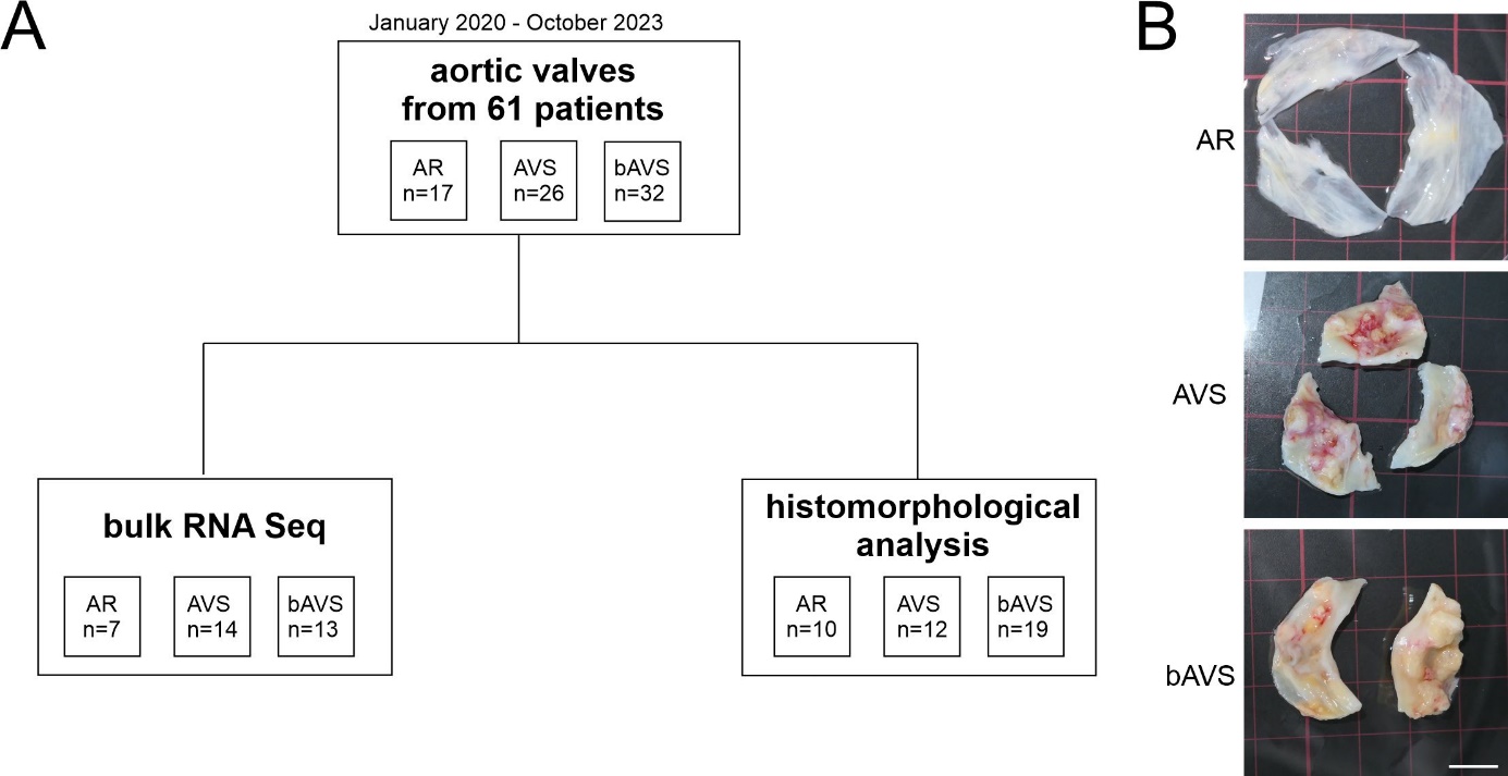 Basic Res Cardiol:二叶式主动脉瓣狭窄的血管生成、炎症与局部钙化特征-香草杏仁