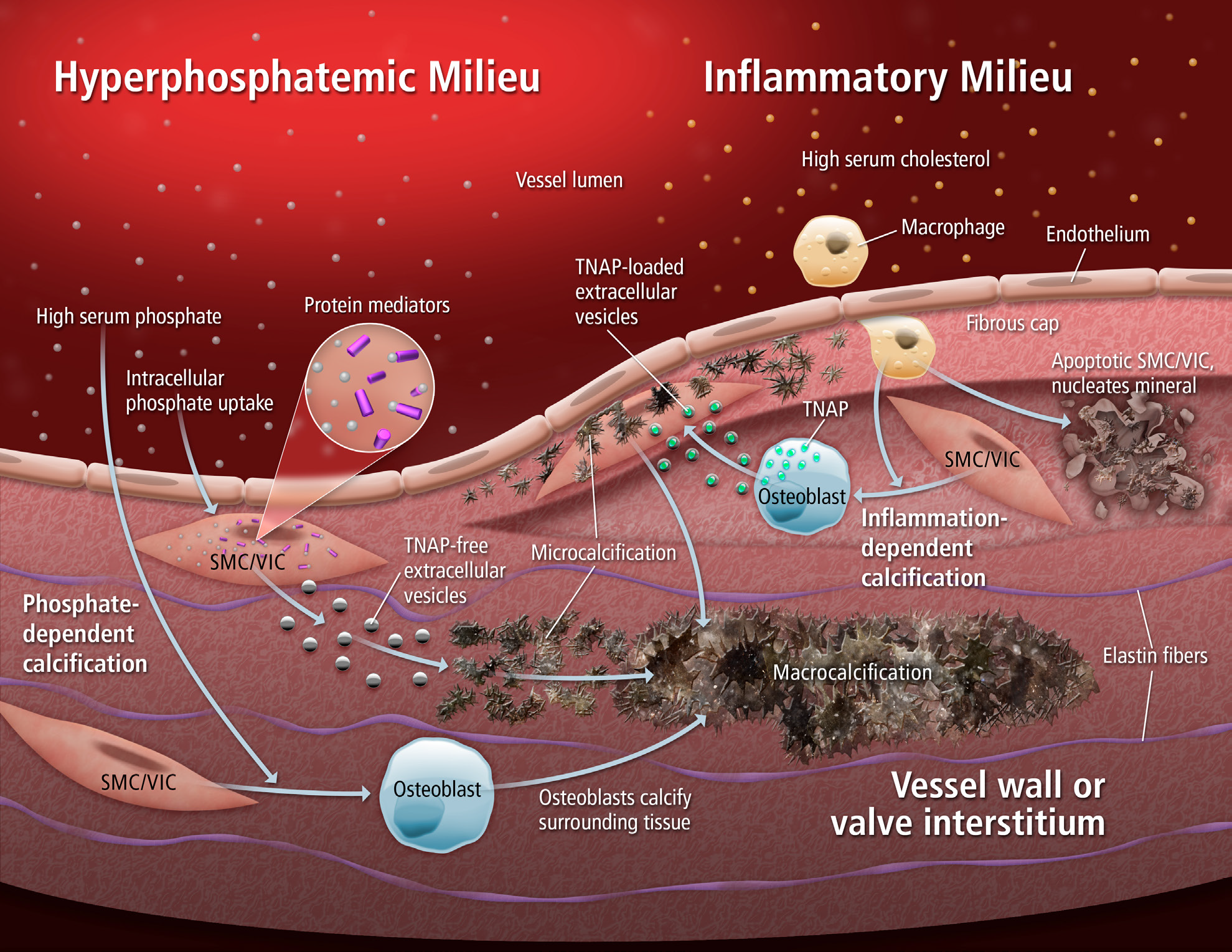 Giving Calcification Its Due: Recognition of a Diverse Disease: A First Attempt to Standardize the Field-香草杏仁