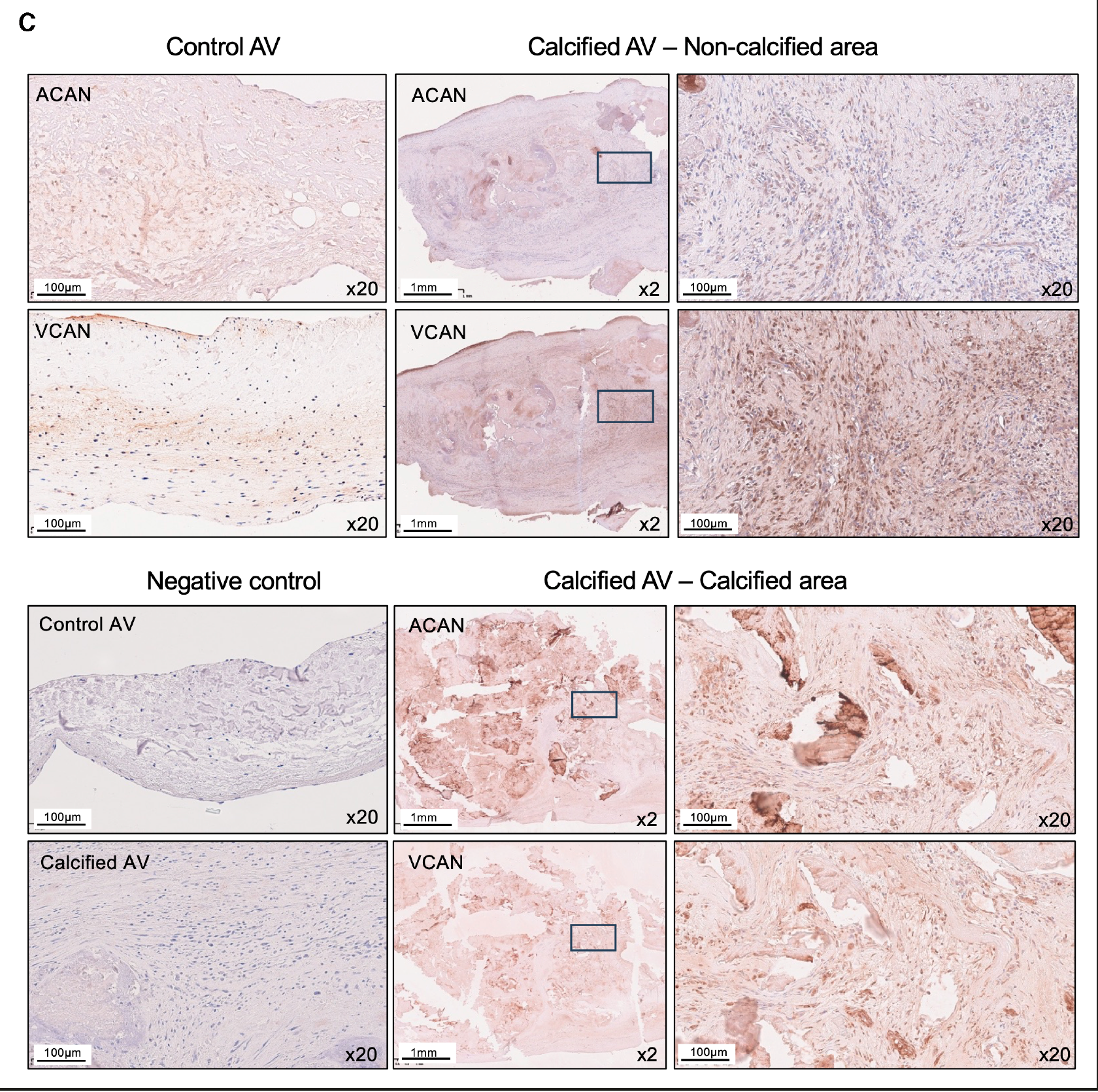 Figure 3C:VCAN、ACAN 在人瓣膜中的组织分布与阴性对照